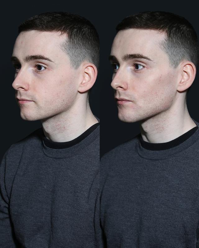 Unretouched before and after result, the drBand Clinic