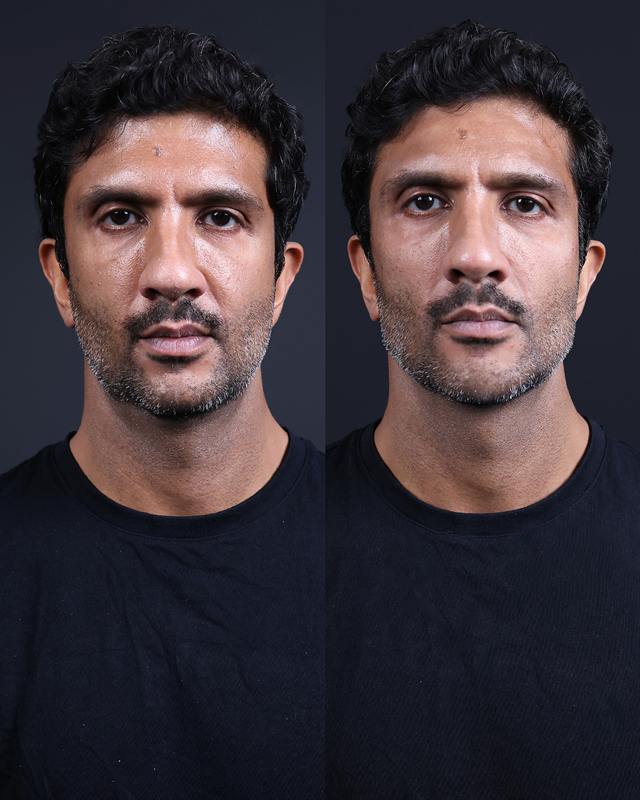 Unretouched before and after result, the drBand Clinic