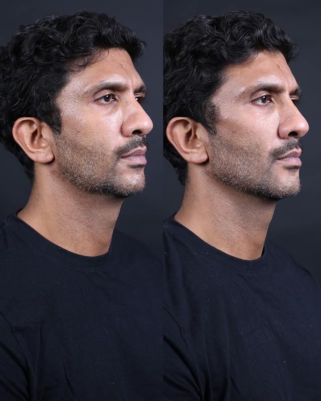 Unretouched before and after result, the drBand Clinic