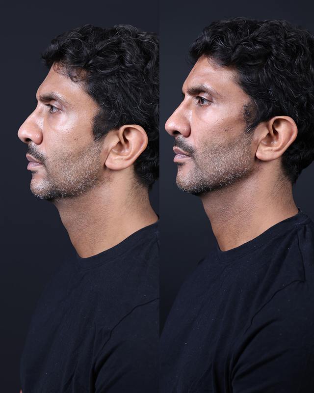 Unretouched before and after result, the drBand Clinic