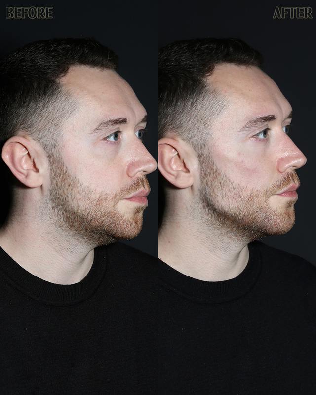 Unretouched before and after result, the drBand Clinic