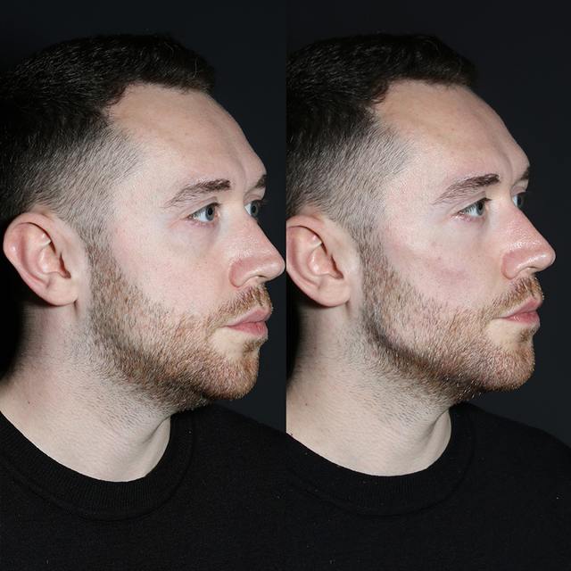 Unretouched before and after result, the drBand Clinic