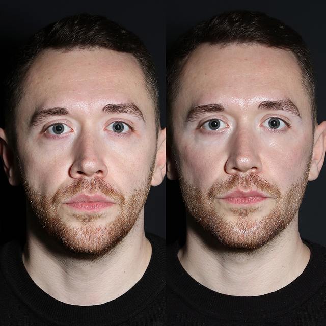 Unretouched before and after result, the drBand Clinic