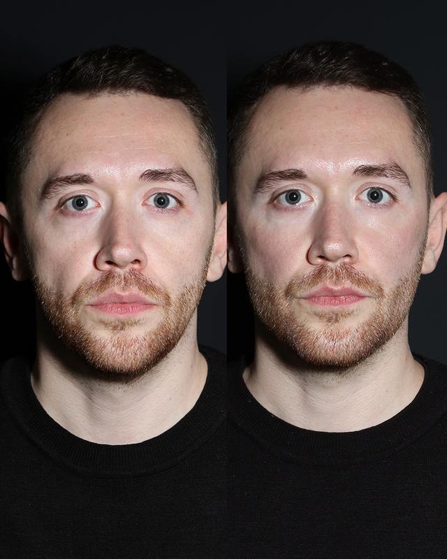 Unretouched before and after result, the drBand Clinic