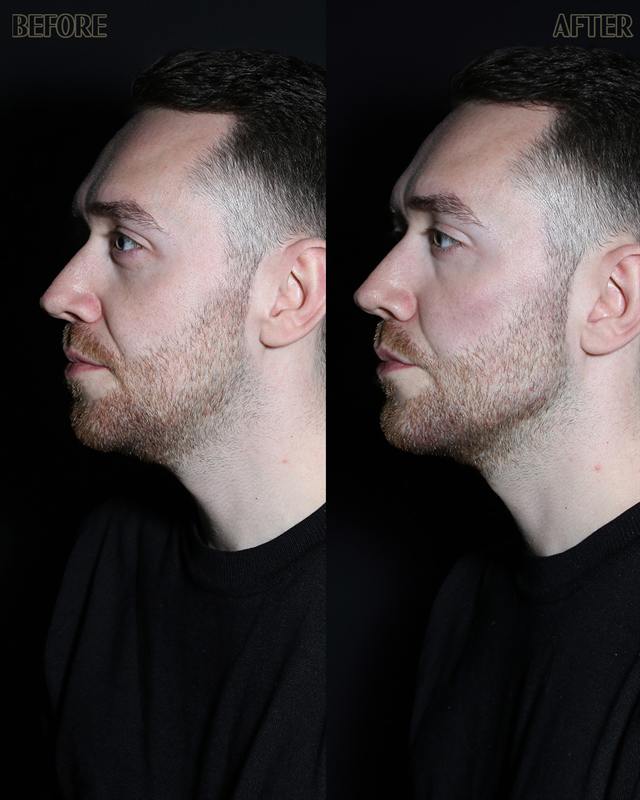 Unretouched before and after result, the drBand Clinic