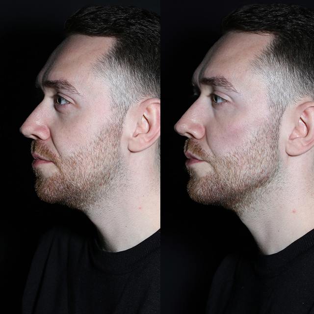 Unretouched before and after result, the drBand Clinic
