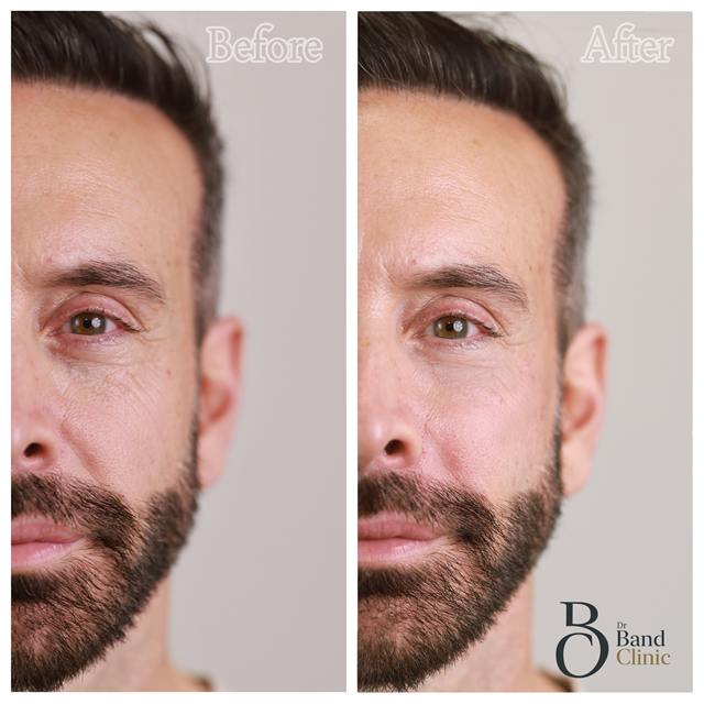 Unretouched before and after result, the drBand Clinic