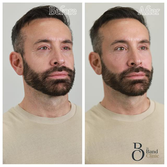Unretouched before and after result, the drBand Clinic