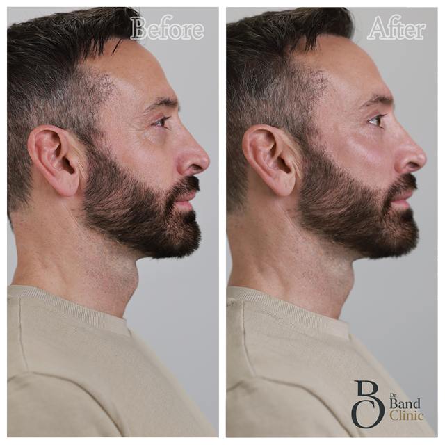 Unretouched before and after result, the drBand Clinic