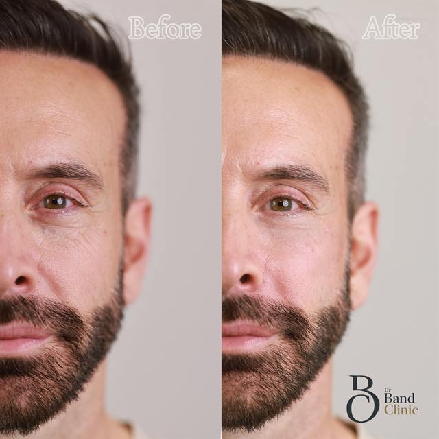 Unretouched before and after result, the drBand Clinic