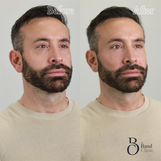 Unretouched before and after result, the drBand Clinic