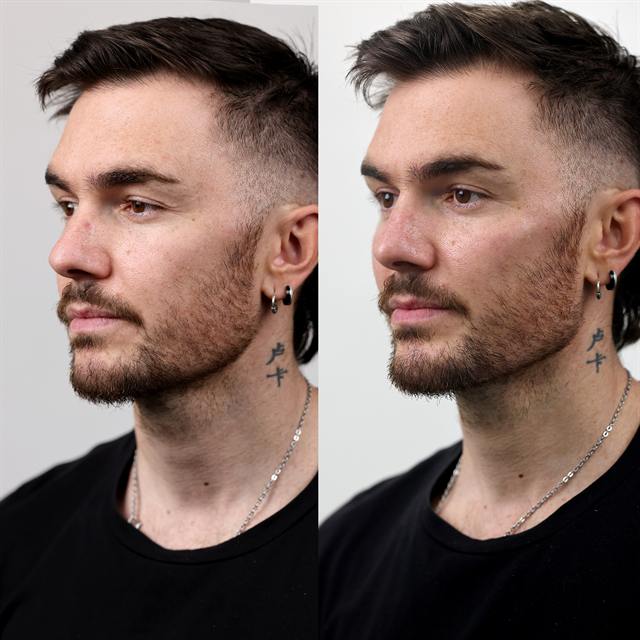 Unretouched before and after result, the drBand Clinic