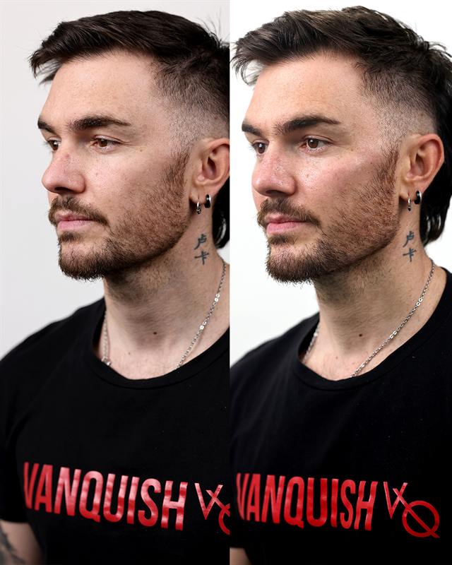 Unretouched before and after result, the drBand Clinic