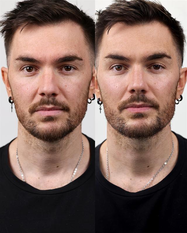 Unretouched before and after result, the drBand Clinic
