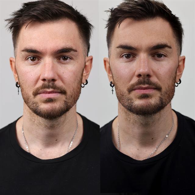 Unretouched before and after result, the drBand Clinic