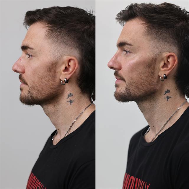 Unretouched before and after result, the drBand Clinic