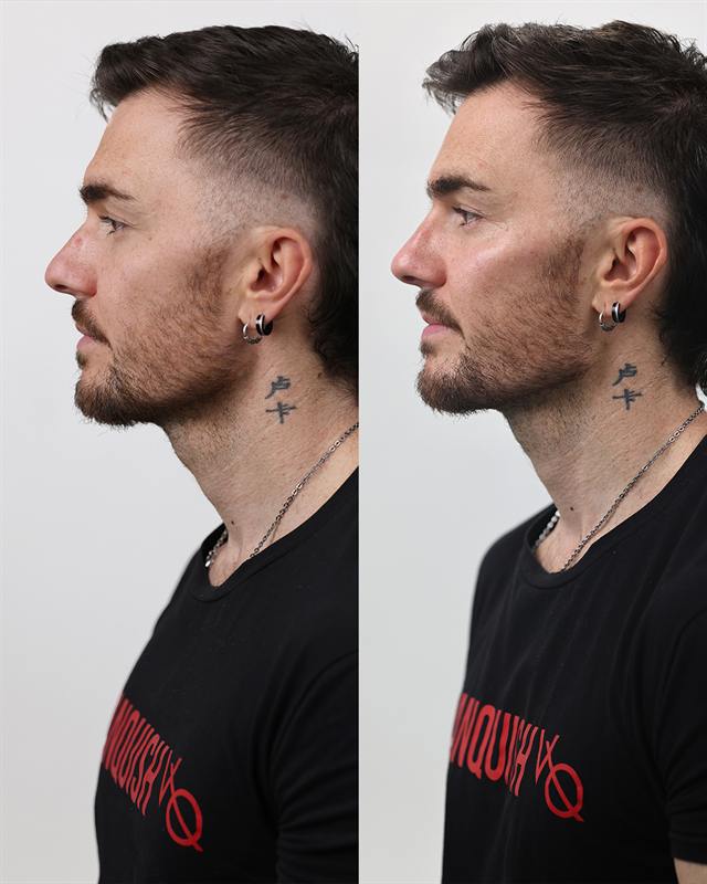 Unretouched before and after result, the drBand Clinic