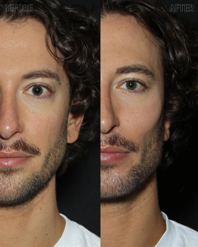 Unretouched before and after result, the drBand Clinic