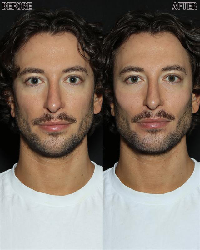 Unretouched before and after result, the drBand Clinic