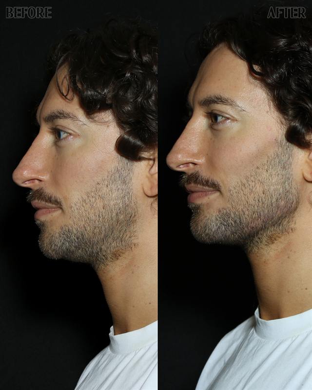 Unretouched before and after result, the drBand Clinic