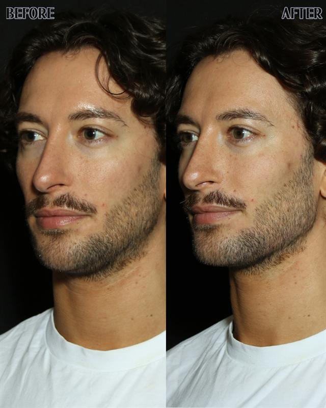 Unretouched before and after result, the drBand Clinic