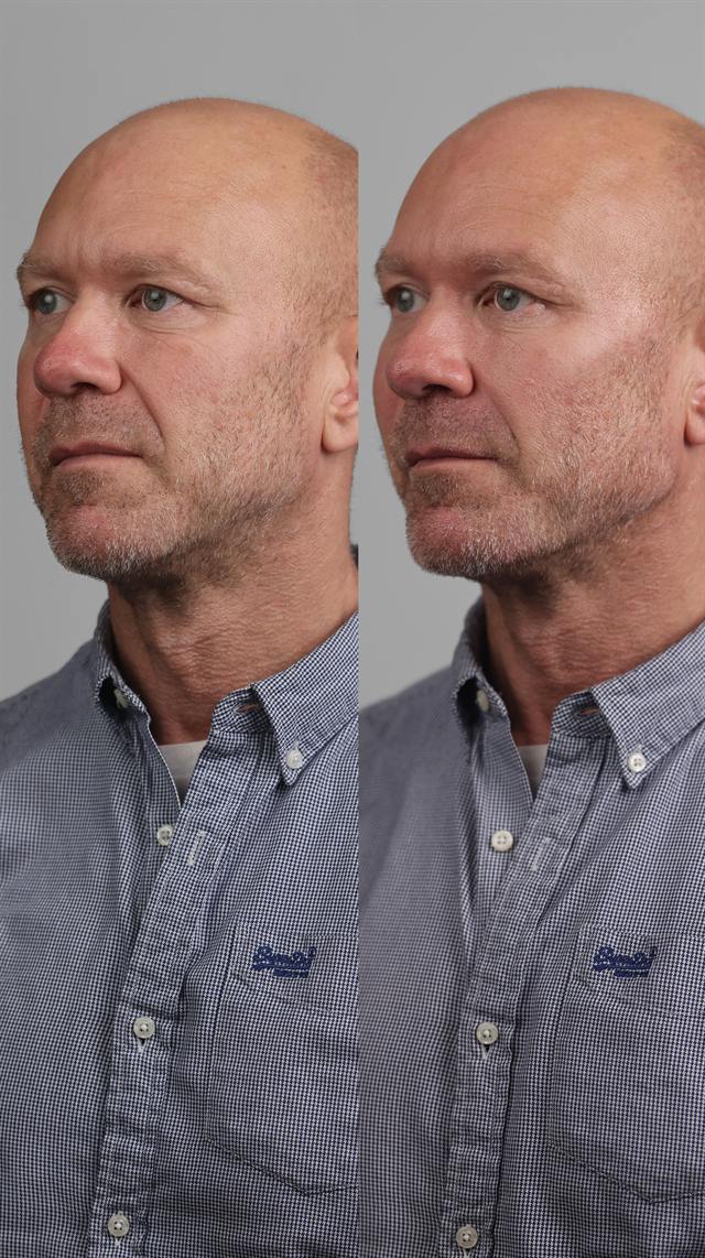 Unretouched before and after result, the drBand Clinic