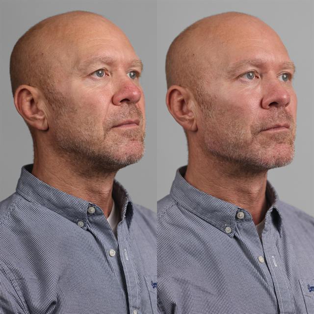 Unretouched before and after result, the drBand Clinic