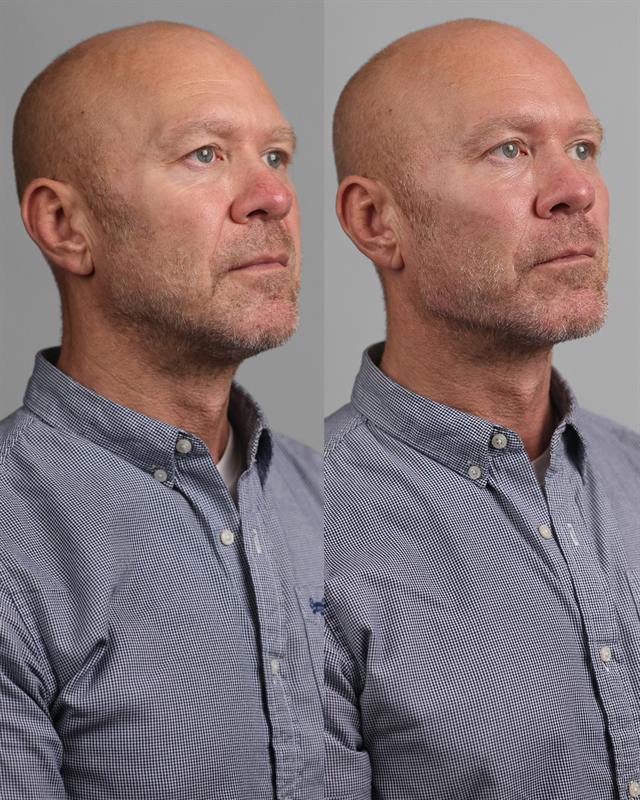 Unretouched before and after result, the drBand Clinic
