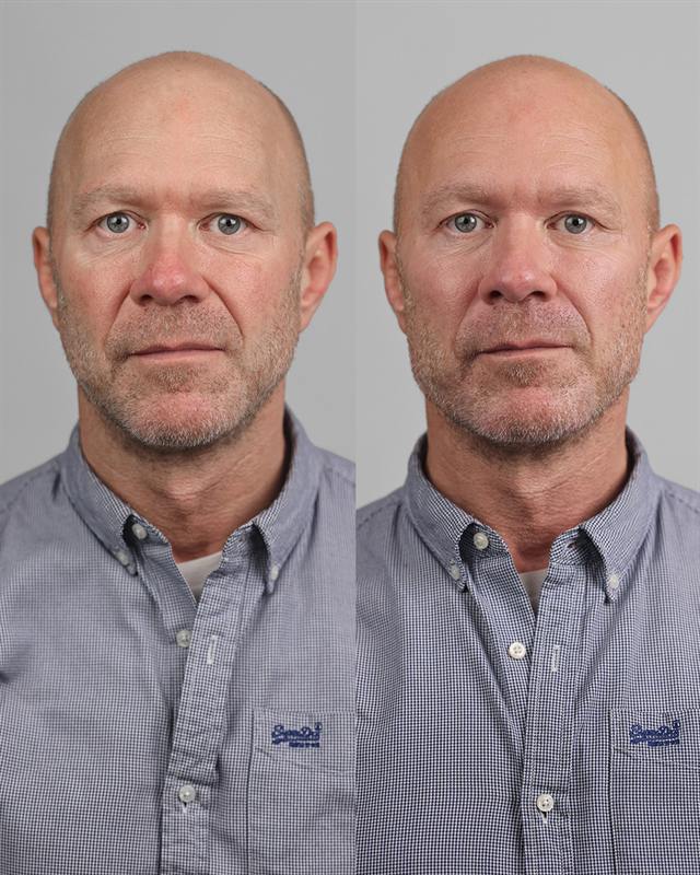 Unretouched before and after result, the drBand Clinic