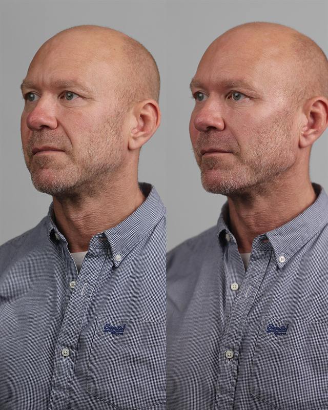 Unretouched before and after result, the drBand Clinic