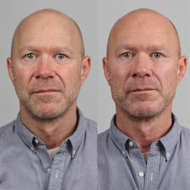 Unretouched before and after result, the drBand Clinic