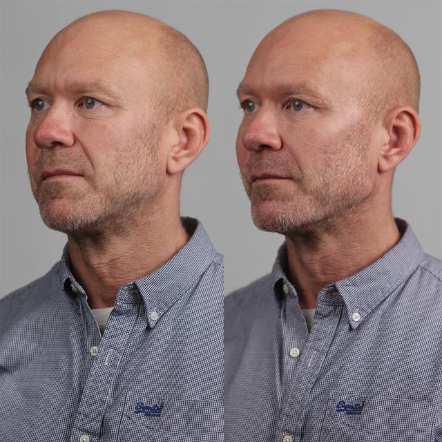 Unretouched before and after result, the drBand Clinic