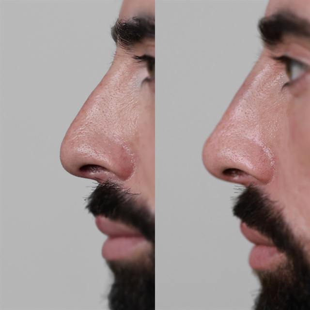 Unretouched before and after result, the drBand Clinic