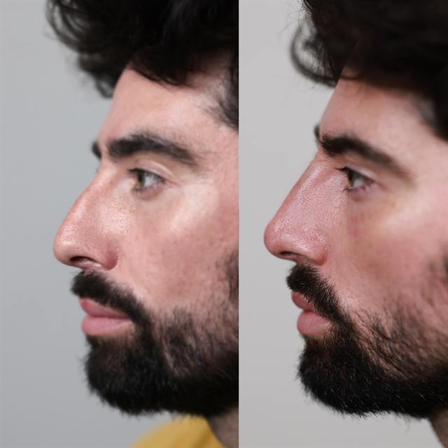 Unretouched before and after result, the drBand Clinic