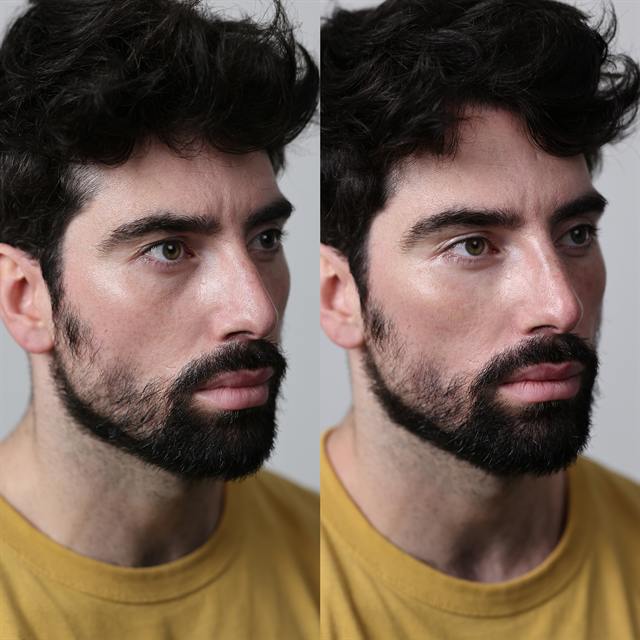 Unretouched before and after result, the drBand Clinic