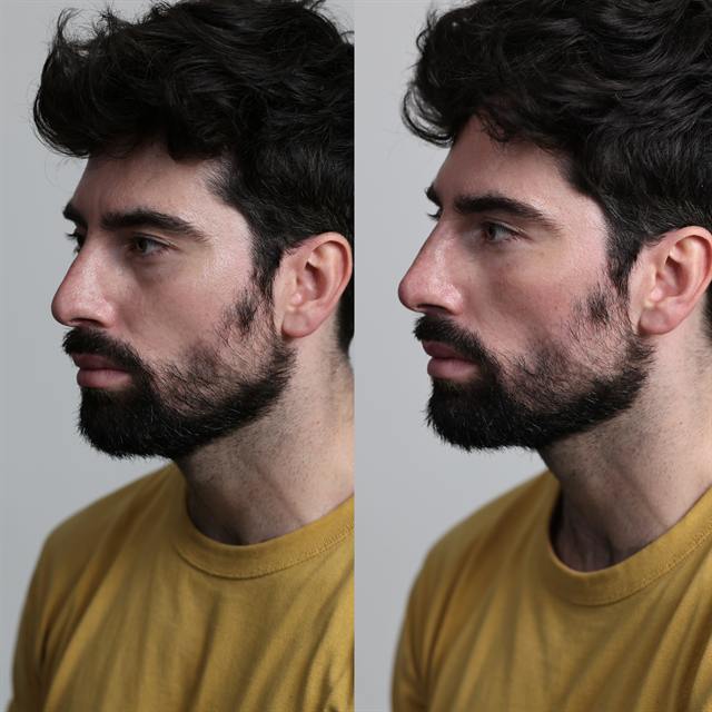 Unretouched before and after result, the drBand Clinic