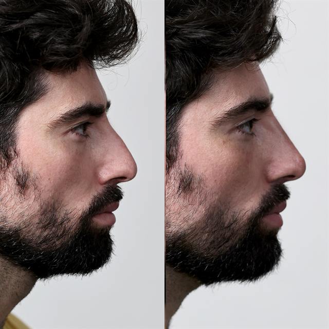 Unretouched before and after result, the drBand Clinic