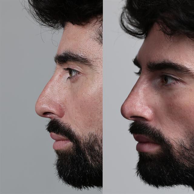 Unretouched before and after result, the drBand Clinic