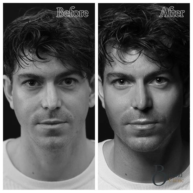 Unretouched before and after result, the drBand Clinic