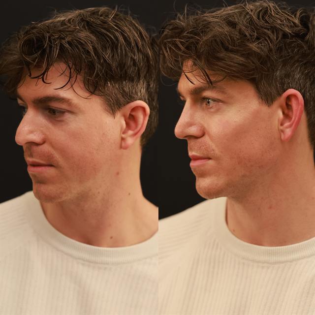 Unretouched before and after result, the drBand Clinic