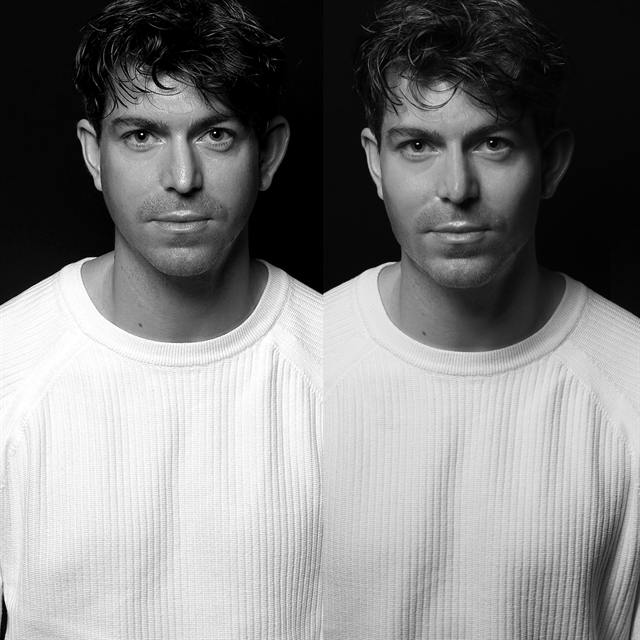 Unretouched before and after result, the drBand Clinic