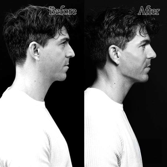 Unretouched before and after result, the drBand Clinic