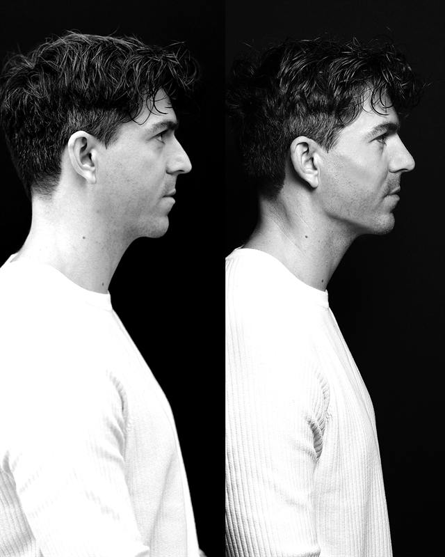 Unretouched before and after result, the drBand Clinic