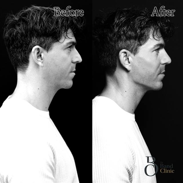 Unretouched before and after result, the drBand Clinic