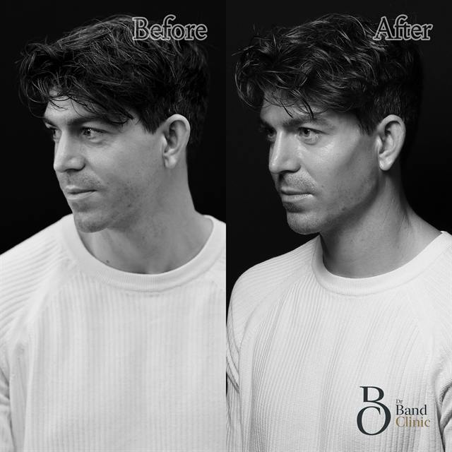 Unretouched before and after result, the drBand Clinic