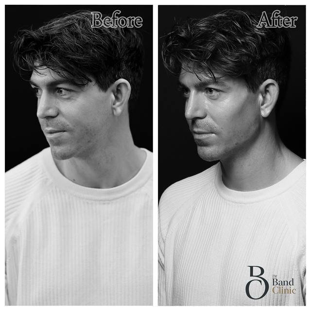 Unretouched before and after result, the drBand Clinic