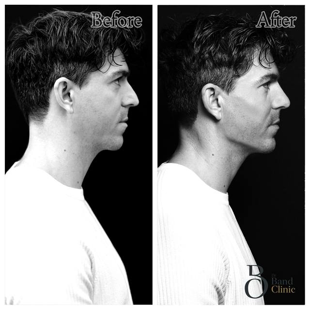 Unretouched before and after result, the drBand Clinic