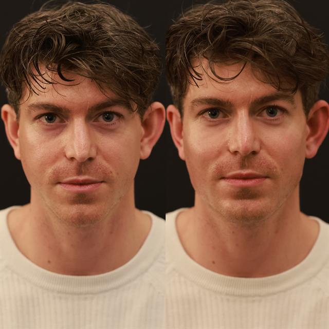 Unretouched before and after result, the drBand Clinic