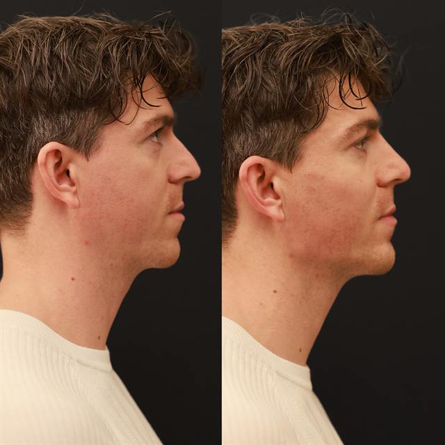Unretouched before and after result, the drBand Clinic