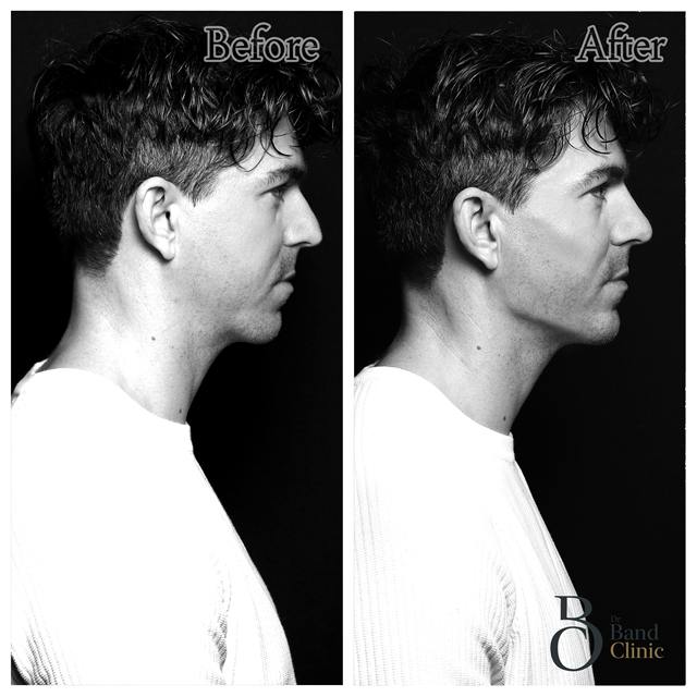 Unretouched before and after result, the drBand Clinic